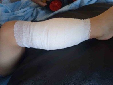 Pitpull Cinsi Köpegin Saldirdigi 5 Yasindaki Çocuk Hastanelik Oldu