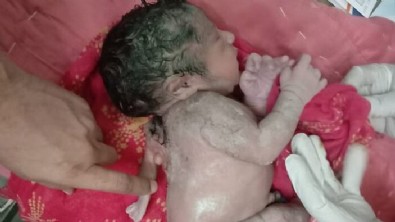 Hindistan'da bir bebek, sırtında ek bir kolla dünyaya geldi