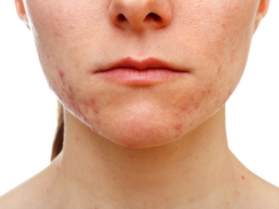 2030 Yilinda Toplumun Yüzde 50'Si Alerjik Hasta Olabilir