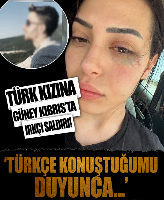Kıbrıs Türkü Asya Karaali’ye ırkçı saldırı: Dişlerini ve parmağını kırdılar! Duvardan attılar…