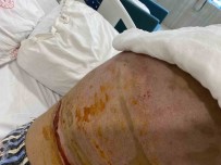 Beyoglu'nda Barda Yanan Genç Kiz Dehset Anlarini Anlatti Açiklamasi 'Bir Anda Alev Topuna Döndüm'