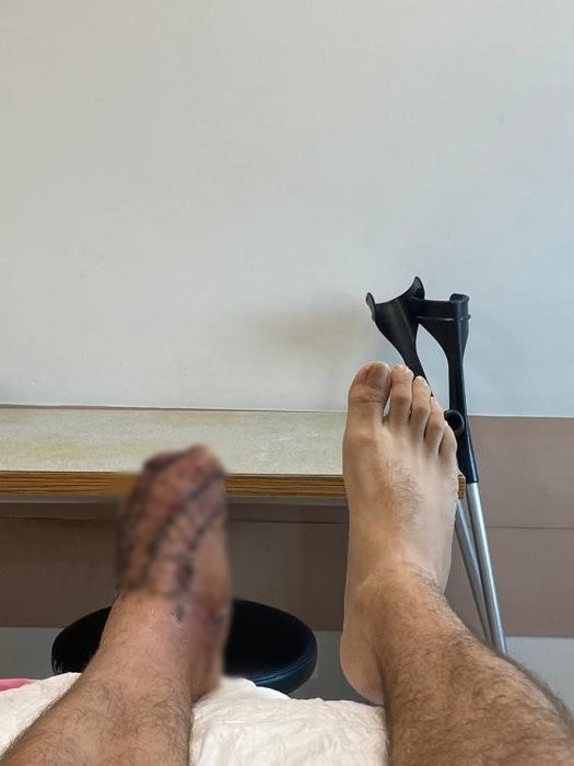 İBB personeli dehşeti! Belediye aracıyla vatandaşı ezdi: 5 parmağını kaybetti