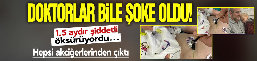 1,5 aydır öksürüyordu doktorlar bile şoke oldu: Hepsi akciğerinden çıktı!