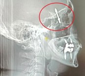 Bursa'da Inanilmaz Olay Açiklamasi Implant Tedavisinde Vida Beynine Saplandi Haberi