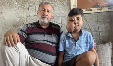 Milyonda bir görülen hastalık: İki farklı yüzü var gibi görünüyor