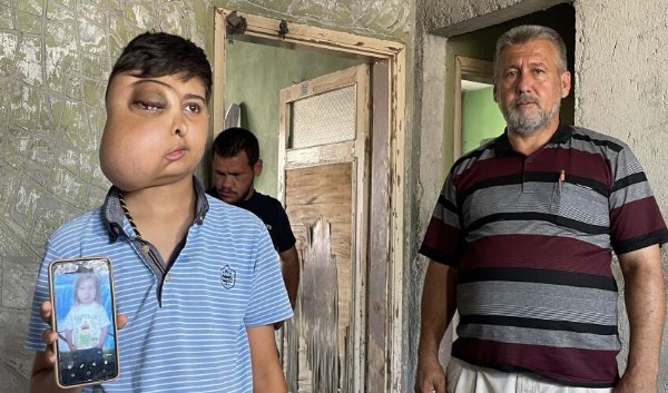 Milyonda bir görülen hastalık: İki farklı yüzü var gibi görünüyor