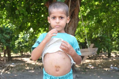 Köpeklerin Saldirdigi Çocuk 18 Gün Sonra Taburcu Oldu