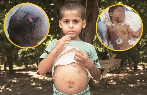 Köpek saldırısı dehşet saçtı! 5 yaşındaki çocuk 18 gün yaşam mücadelesi verdi: 'Köpekler hala burada'