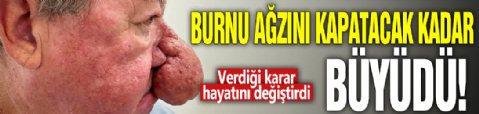 Burnu ağzını kapatacak kadar büyüdü! Verdiği karar hayatını değiştirdi
