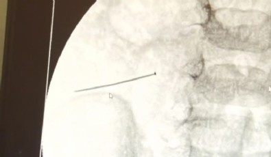 2 Yaşındaki Bebeğin Bağırsağından İğne Çıktı!