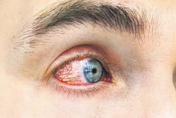 Göz Sağlığının Sinsi Düşmanı!