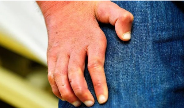 Avrupa'da Cüzzam Vakası!