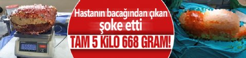 Hastanın bacağından çıkan şoke etti! Tam 5 kilo 668 gram