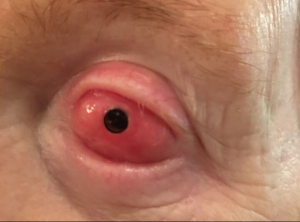 Görme engellilere umut ışığı! Dişten alınan parça göze takıldı