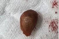 Kurtuldum zannetti, akciğerinden oldu! Küçücük çekirdek canından ediyordu