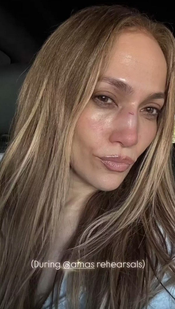 Jennifer Lopez'in yüzüne dikiş atıldı