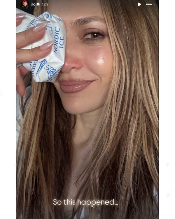 Jennifer Lopez'in yüzüne dikiş atıldı