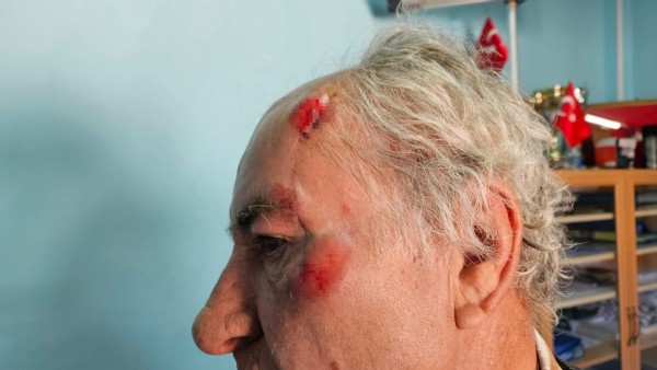 Burdur'da köpeklerin saldırısına uğrayan adam, yaralandı