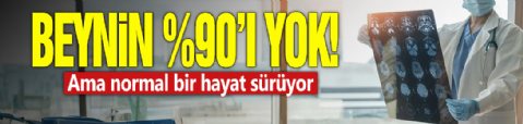 Beyninin %90’ı yok! Ama normal bir hayat sürüyor