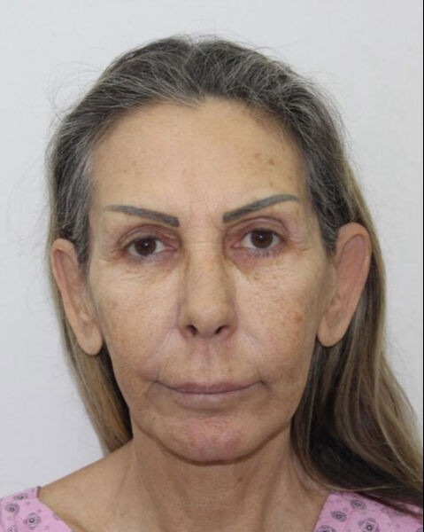 Estetik yaptırdı! Gören dönüp bir daha baktı