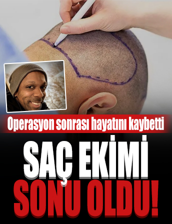 Saç ekimi için İstanbul'a geldi! Operasyon sonrası hayatını kaybetti!